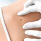 Après une exérèse de tumeur de la peau : quelles techniques de reconstruction ?