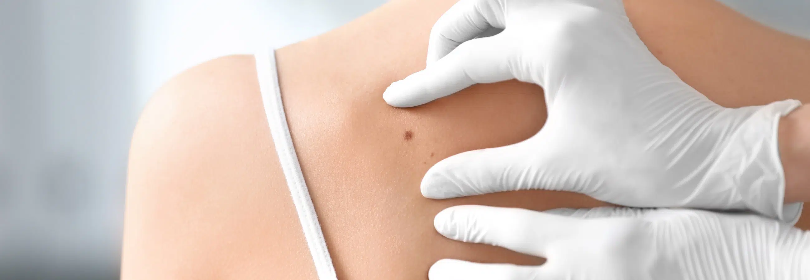 Reconstruction après une exérèse cutanée au Centre Maxillyon à Lyon