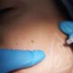 Comment bien préparer son opération de chirurgie orthognathique ?