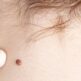 Chirurgie des tumeurs bénignes de la peau : est-ce esthétique ou médical ?