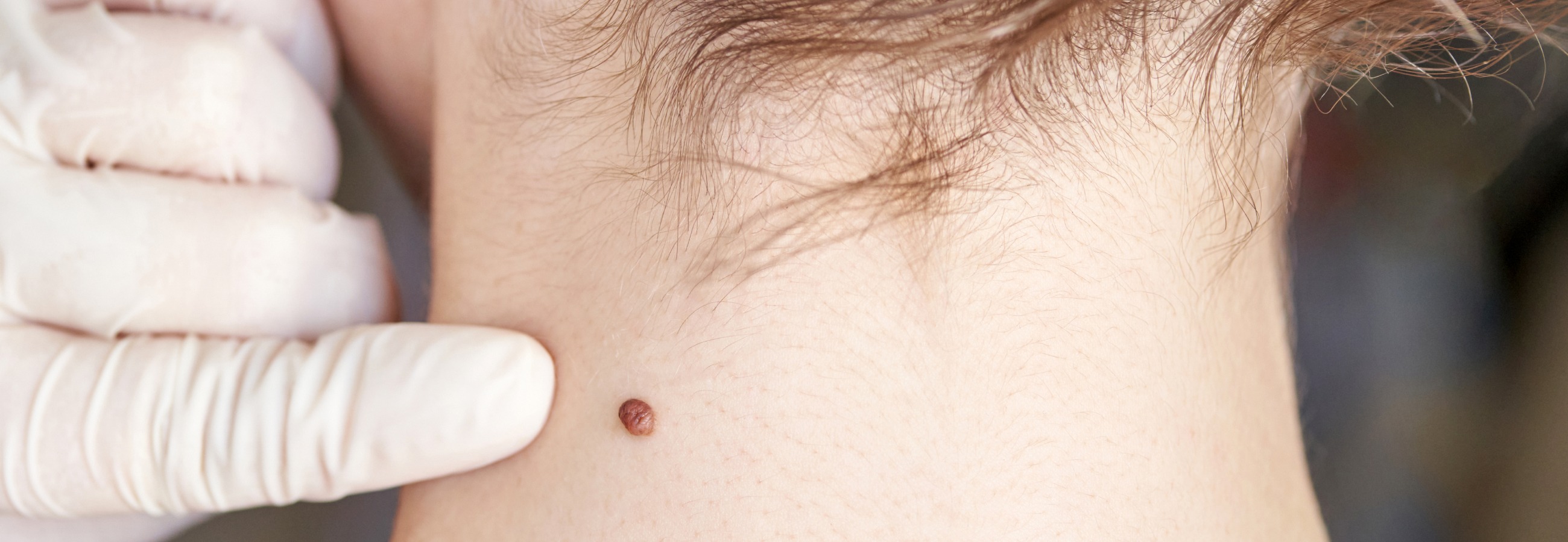 Chirurgie des tumeurs bénignes cutanées