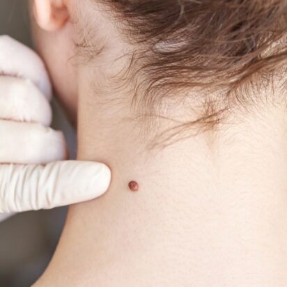 Chirurgie des tumeurs bénignes cutanées