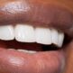 Faut-il systématiquement extraire les dents de sagesse ?