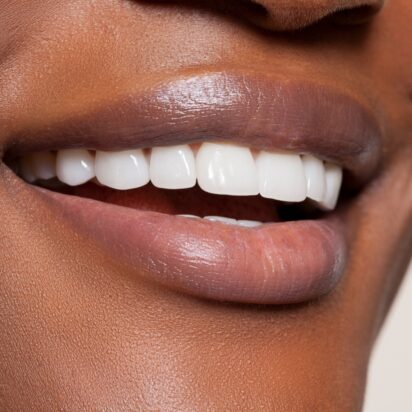 Extraction des dents de sagesse