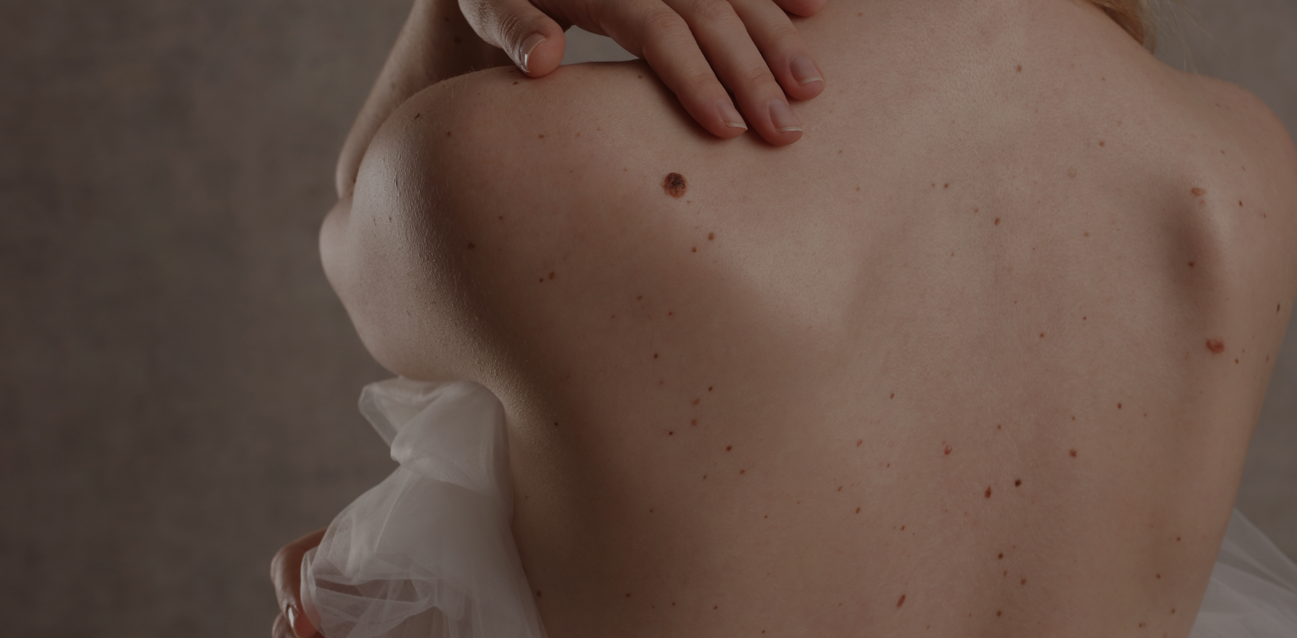 Grain de beauté