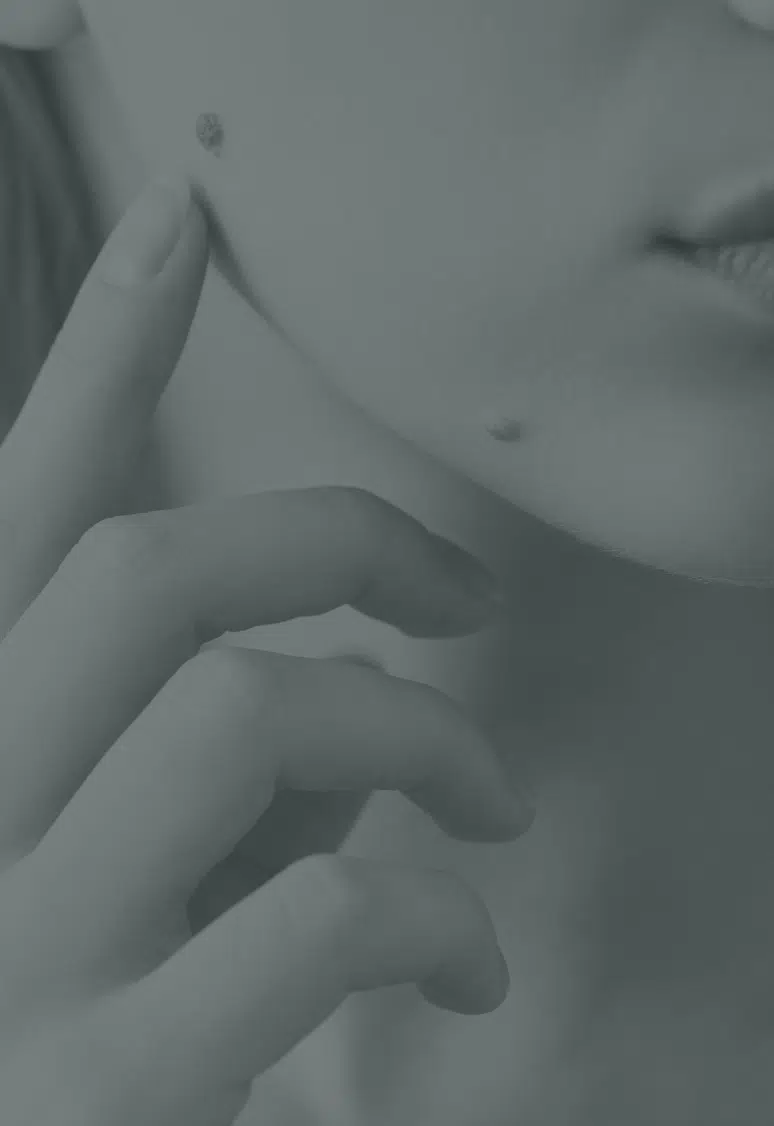 Grain de beauté