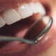 Comment se passe l’opération des dents de sagesse ?