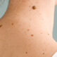 Grain de beauté : quand faut-il envisager une chirurgie dermatologique ?