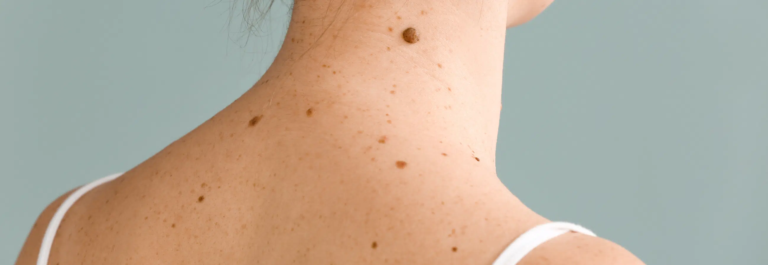 Chirurgie dermatologique pour grain de beauté