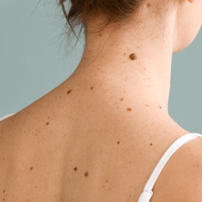 Chirurgie dermatologique pour grain de beauté