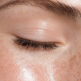 Poches sous les yeux : quand envisager une blépharoplastie ?